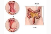 直肠癌化疗适合吃什么中药？能减轻副作用