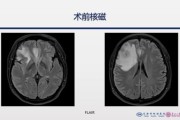 肾癌术后病理级已转移怎么治，治疗方案有哪些？